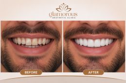 before and after results of Dental veneers in Islamabad , Pakistan (1)