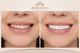 before and after results of Dental veneers in Islamabad , Pakistan