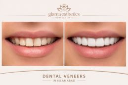 before and after results of Dental veneers in Islamabad Rawalpindi & Pakistan