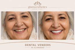 before and after results of Dental veneers in Islamabad