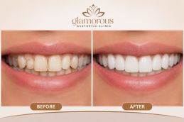 before and after results of Dental veneers in Rawalpindi & Pakistan