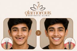 before and after results of dental implant in Islamabad