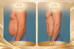 results of Liposuction in Islamabad