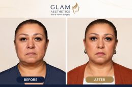 Before and After result of Buccal Fat Removal in Islamabd Rawalpindi & Pakistan (1)