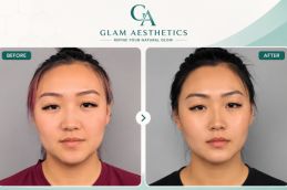 Before and After result of Buccal Fat Removal in Islamabd Rawalpindi & Pakistan