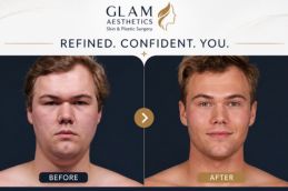 Before and After result of Buccal Fat Removal in Islamabd Rawalpindi & Pakistan