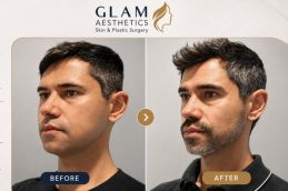 Before and After result of Buccal Fat Removal in Islamabd & Rawalpindi