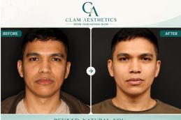 Before and After result of Buccal Fat Removal in Islamabd