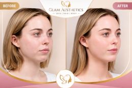 Before and After result of Buccal Fat Removal