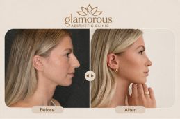 Best Cosmetic Surgeon results for Nose Tip Plasty ( Rhinoplasty )