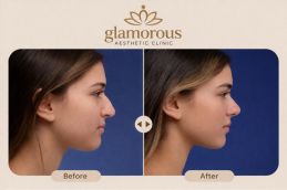 Best Cosmetic Surgeon results for Nose Tip Plasty ( Rhinoplasty ) (2)