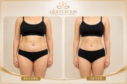 Cost of Body Lift Surgery depend upon different factor you can see result
