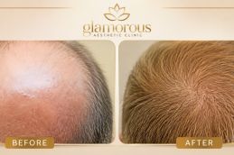 FUE Hair Transplant Results Rawalpindi Islamabad Pakistan