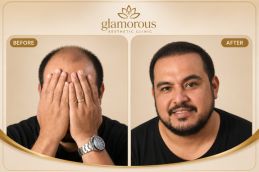 FUE Hair Transplant before and After