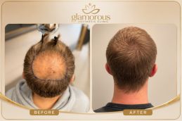 FUE Hair Transplant before and After Rawalpindi Islamabad Pakistan