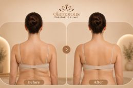 before and after Braline Lift in Islamabad