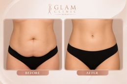 before and after body countouring in Islamabad Pakistan