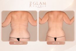 before and after body countouring in Islamabad