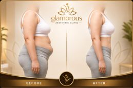 before and after of mounjaro injection in ISlamabad (1)