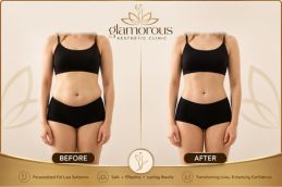 before and after of mounjaro injections in ISlamabad Rawalpindi