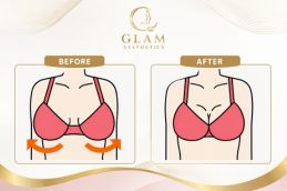 before and after result Braline Lift in Islamabad Rawalpindi Pakistan