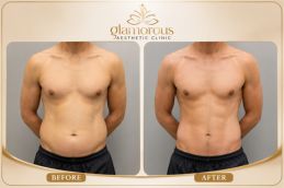 before and after result of body lift surgery