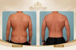 before and after result of body lift surgery in Pakistan