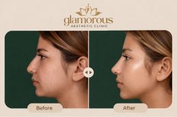 before and after result of rhinoplasty (1)