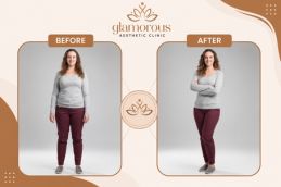 before and after result of weight loss in Islamabad Pakistan