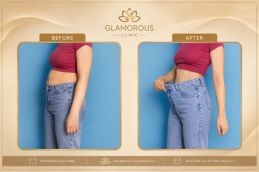 before and after result of weight loss injections (1)