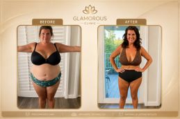 before and after result of weight loss injections