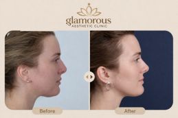Is Rhinoplasty in Islamabad Better Than Fillers?