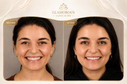 before and after results botox injections Rawalpindi Pakistan