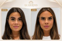 before and after results botox injections pakistan