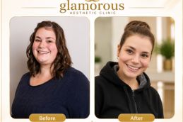 Bariatric Surgery before and After result (1)
