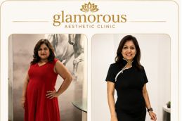 Bariatric Surgery before and After result (2)