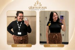 Bariatric Surgery before and After result