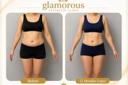 Bariatric Surgery surgery before and After