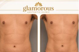 Bariatric surgery before and After results Islamabad