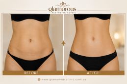 Before and After Result of Lipo Abdominoplasty in iSLAMABAD Pakistan (1)