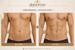 Before and After Result of Lipo Abdominoplasty in iSLAMABAD Pakistan