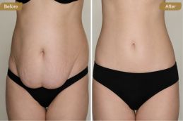 Before and After Result of Lipo Abdominoplasty in iSLAMABAD