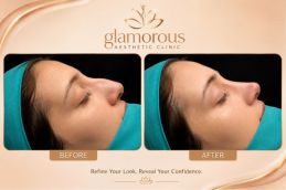 Rhinoplasty Recovery Timeline Week-by-Week Before and After Results