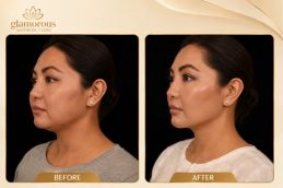 Before and After of chin Liposuction Islamabad Pakistan