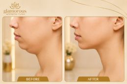 Before and After results of chin Liposuction