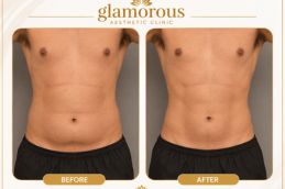 BodyTite Liposuction Before and After results Islamabad Pakistan