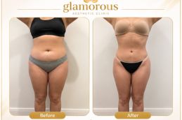 BodyTite Liposuction Before and After results Islamabad