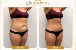 BodyTite Liposuction Before and After results Rawalpindi Islamabad Pakistan