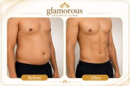BodyTite Liposuction Before and After results Rawapindi Pakistan