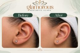 Ear Piercing results in Islamabad